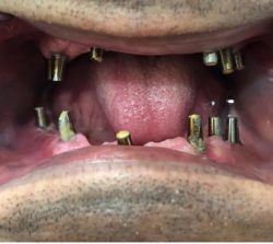 implant derya diş polikliniği
