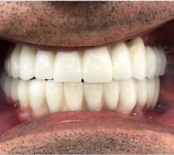 implant uygulaması derya diş fındıklı polikliniği