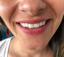 zirkonyum kaplama fındıklı ağız diş polikliniği